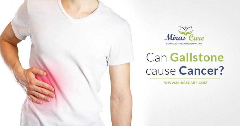 Read more about the article Can Gallstone cause Cancer?