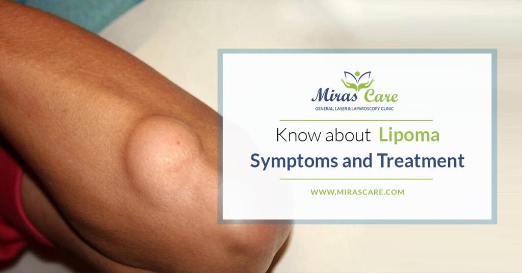 Detailed Account of Lipoma Symptoms and Treatment