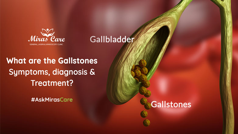 gall bladder stone symptoms
