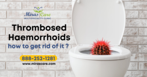 Read more about the article What are Thrombosed Haemorrhoids or piles?