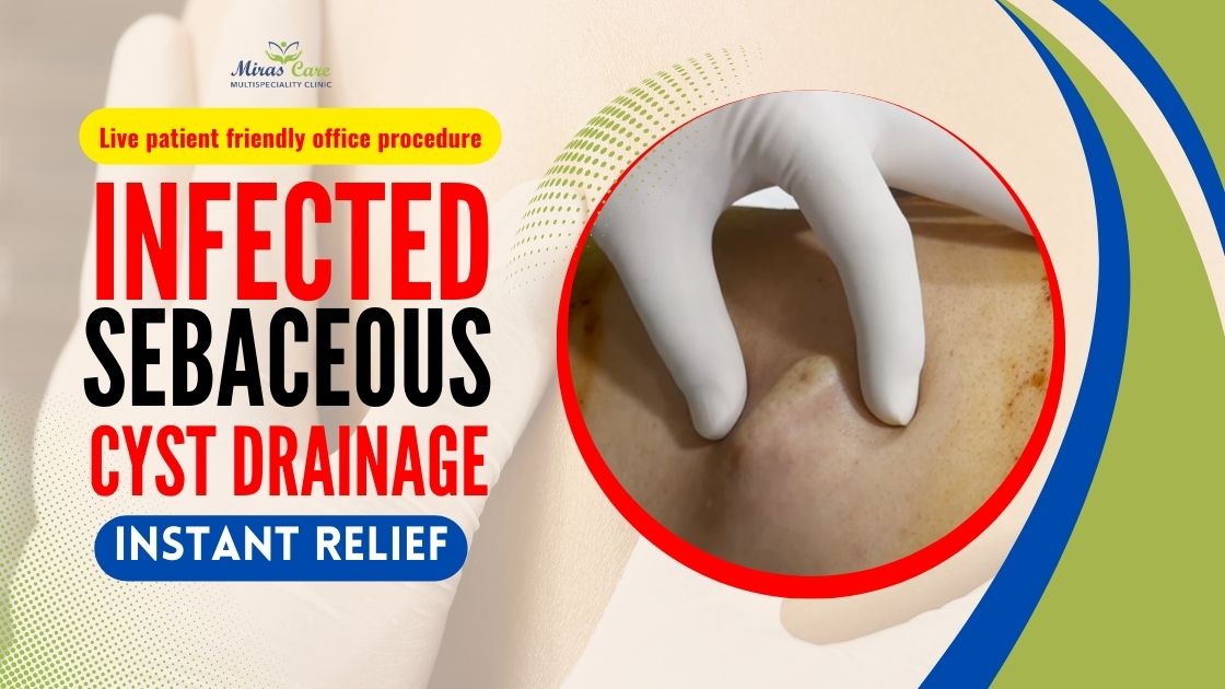 Infected sebaceous cyst treatment